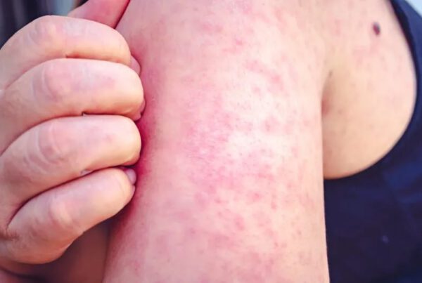 Close-up of a person’s arm with a red, blotchy rash, a common symptom of measles.