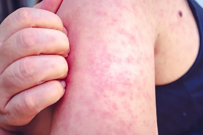 Close-up of a person’s arm with a red, blotchy rash, a common symptom of measles.